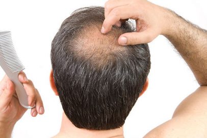 Hair_loss Hair_loss