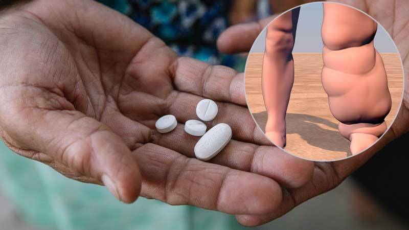 hattipaile_elephantiasis